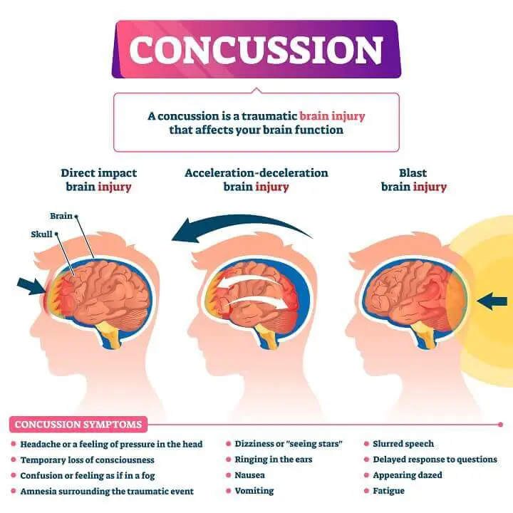 Concussion Illustration
